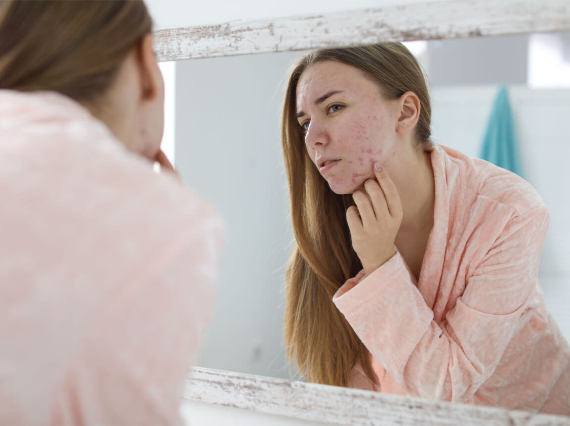 Ženy, pleť so sklonom k akné 