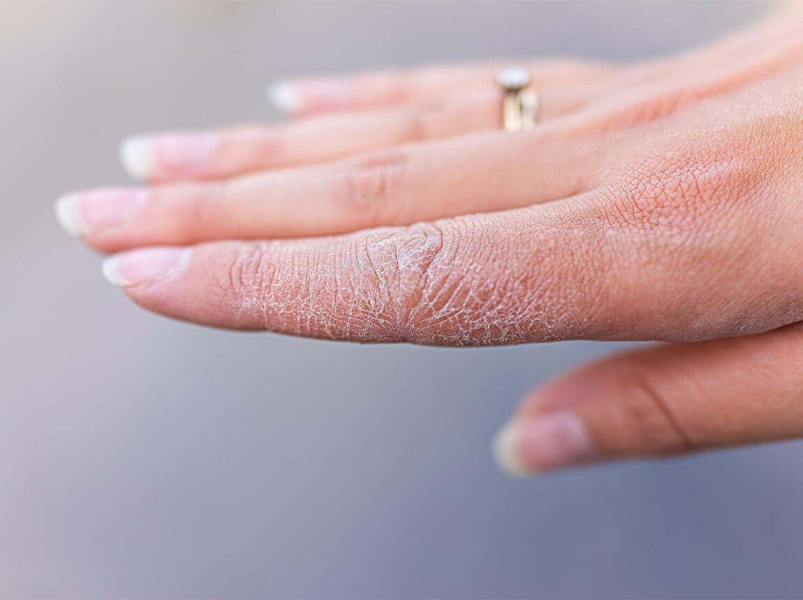 popraskaná pokožka na rukách 