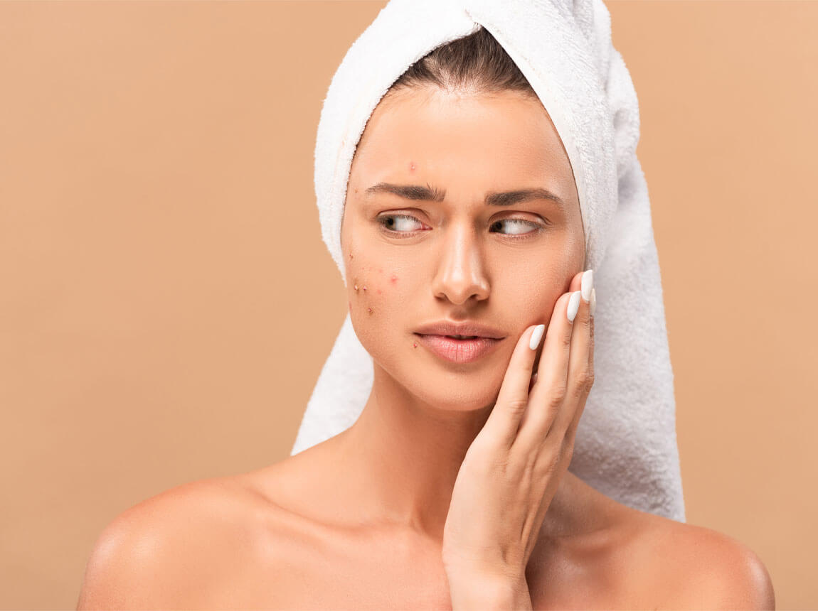 žena s akné - zinok 