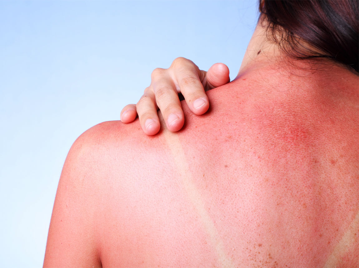 opaľovacie popáleniny - slnečné popáleniny