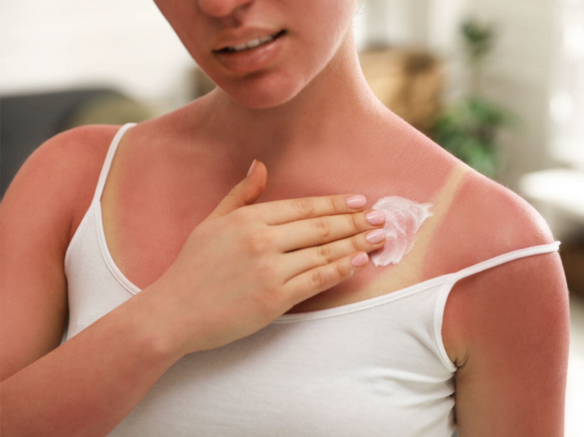 žena - popáleniny od slnka