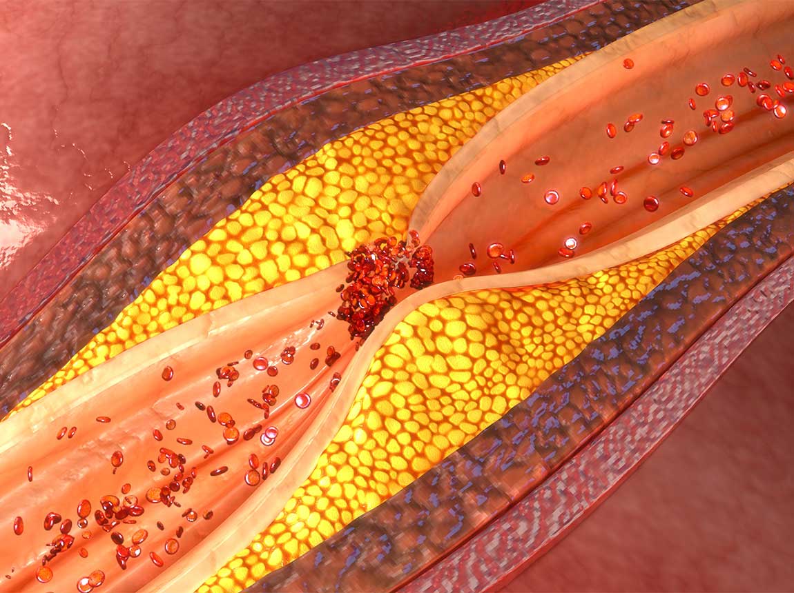 žil &ndash; cholesterol