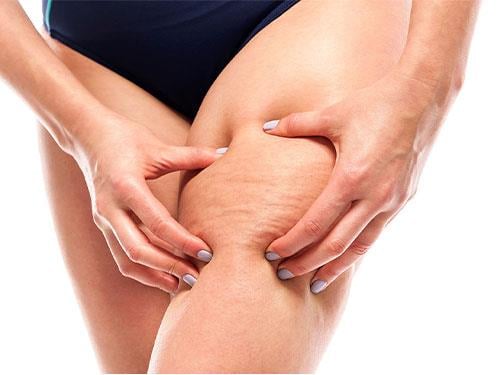 Môže kofeín pomôcť v boji proti celulitíde?