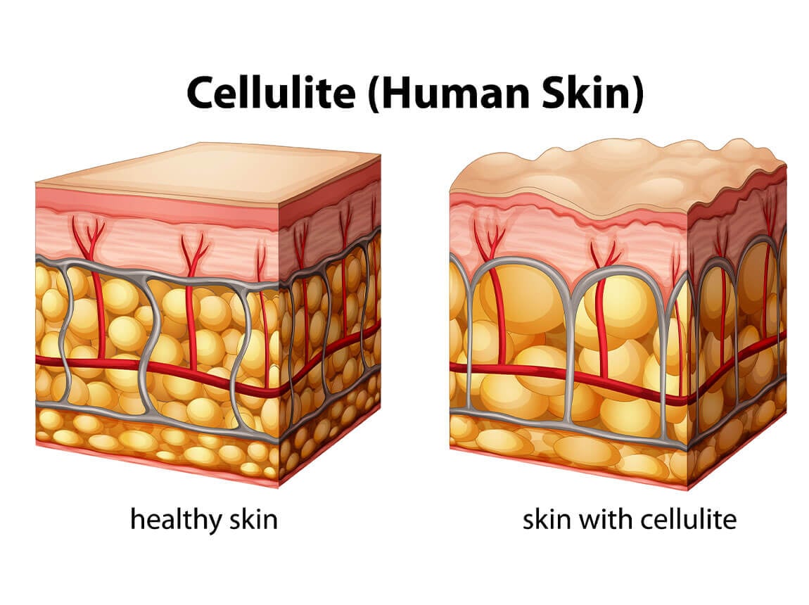 celulit&iacute;da - koža