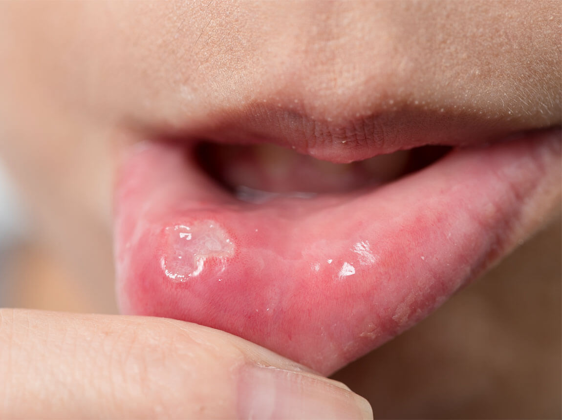 vredy v &uacute;stach